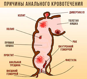 Кровотечение при геморрое