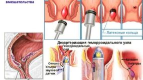 Все способы лечения геморроя