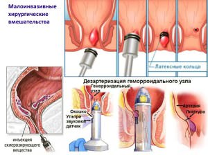 Все способы лечения геморроя Лечение