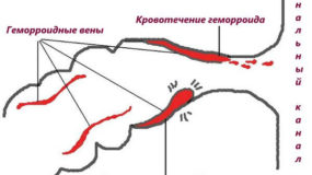 Кровотечение при геморрое: причины и когда нужен врач