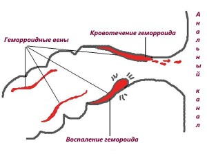 Кровотечение при геморрое
