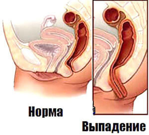 Геморрой