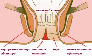 Трещина заднего прохода