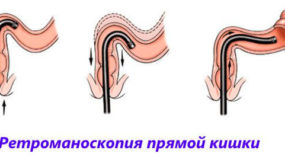 Насколько опасны болезни анального отверстия и прямой кишки