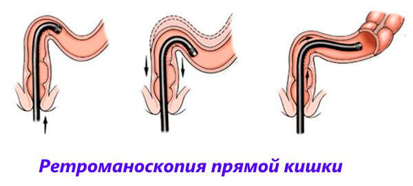 Ретроманоскопия прямой кишки