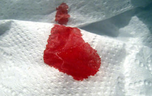 Капля крови на салфетке после дефекации