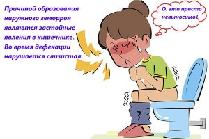 Геморрой