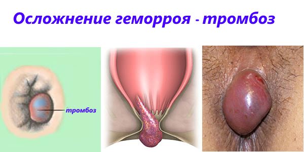 Осложнение геморроя - тромбоз узлов