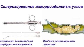 Склеротерапия при геморрое: что это и кому подходит Склеротерапия при геморрое: что это и кому подходит