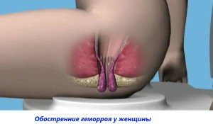 Геморрой у женщин