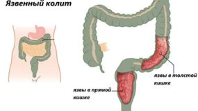 Как распознать и лечить язву прямой кишки