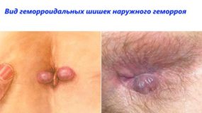 Как выглядят на фото шишки геморроя? Как выглядят на фото шишки геморроя?
