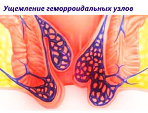 Ущемление, тромбоз геморроидальных узлов