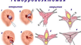 Методы радикальной хирургии – геморроидэктомия