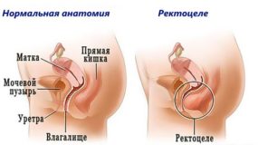 Почему возникают болезни прямой кишки?