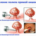 Полипы прямой кишки: когда нужно удаление