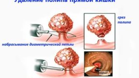 Полипы прямой кишки: когда нужно удаление