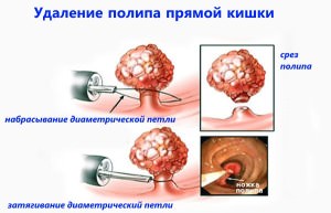 Операция геморроя