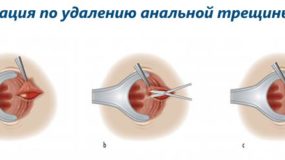 Устранение анальных трещин хирургическим способом