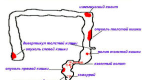 Чем может сопровождаться выделение крови из прямой кишки