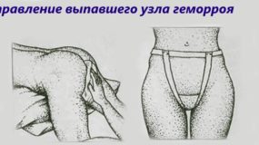 Что делать, если выпали геморроидальные узлы?