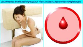 Иссечение анальной трещины: операция и период восстановления