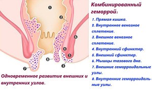 Геморрой