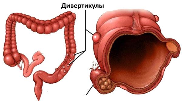 Дивертикул кишечника картинки