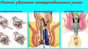 Какими способами проводят удаление геморроя