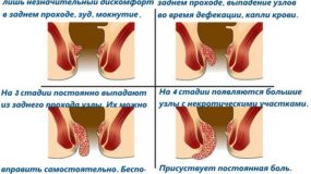 Виды геморроя у беременных женщин