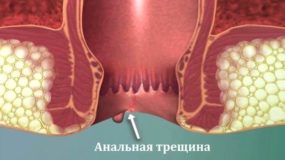 Анальная трещина