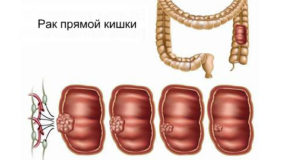 Рак прямой кишки