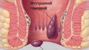 Внутренний и наружный геморрой